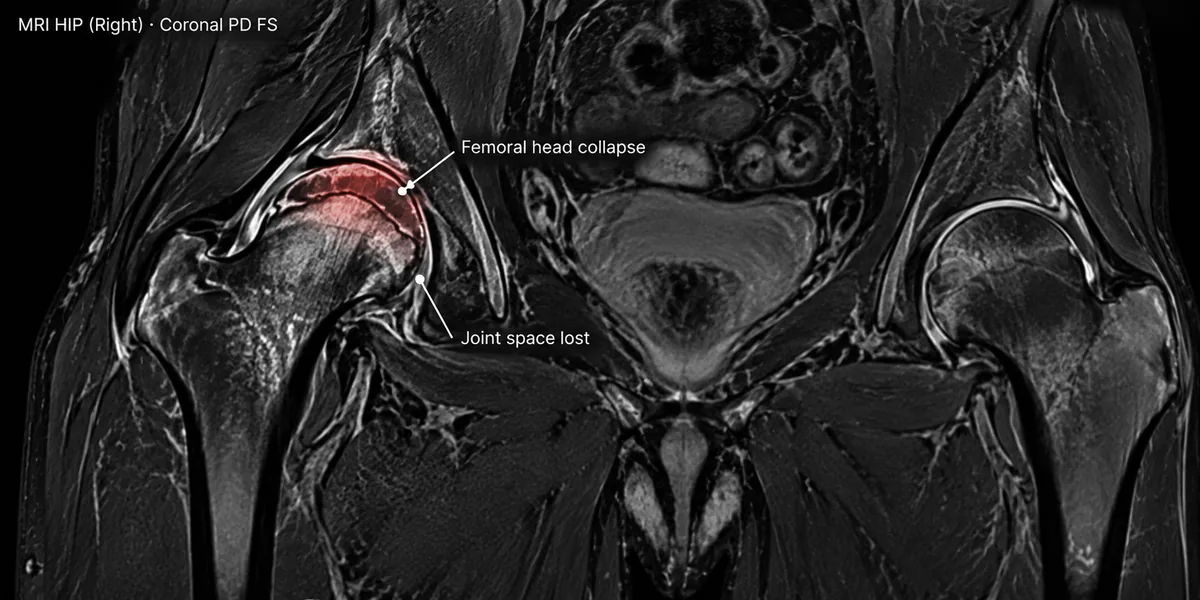 A hip replacement, illustrated MRI