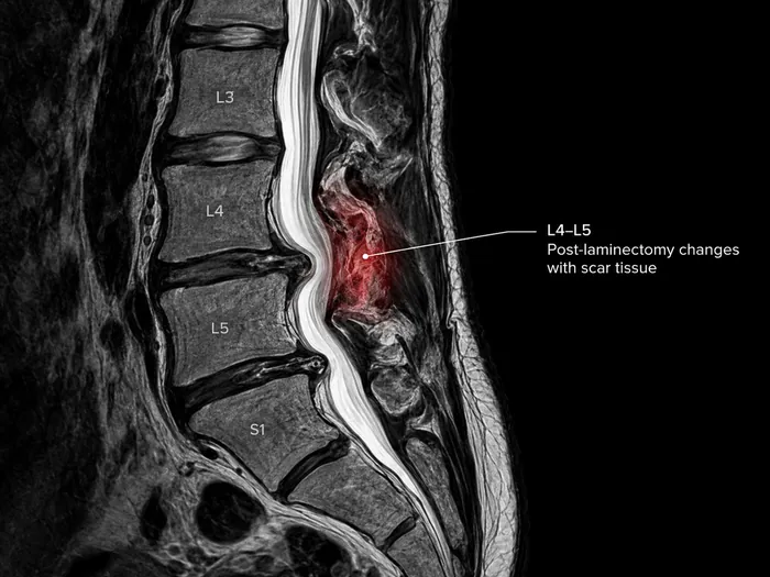 Lumbar MRI marking post-laminectomy changes with scar tissue at L4-L5.