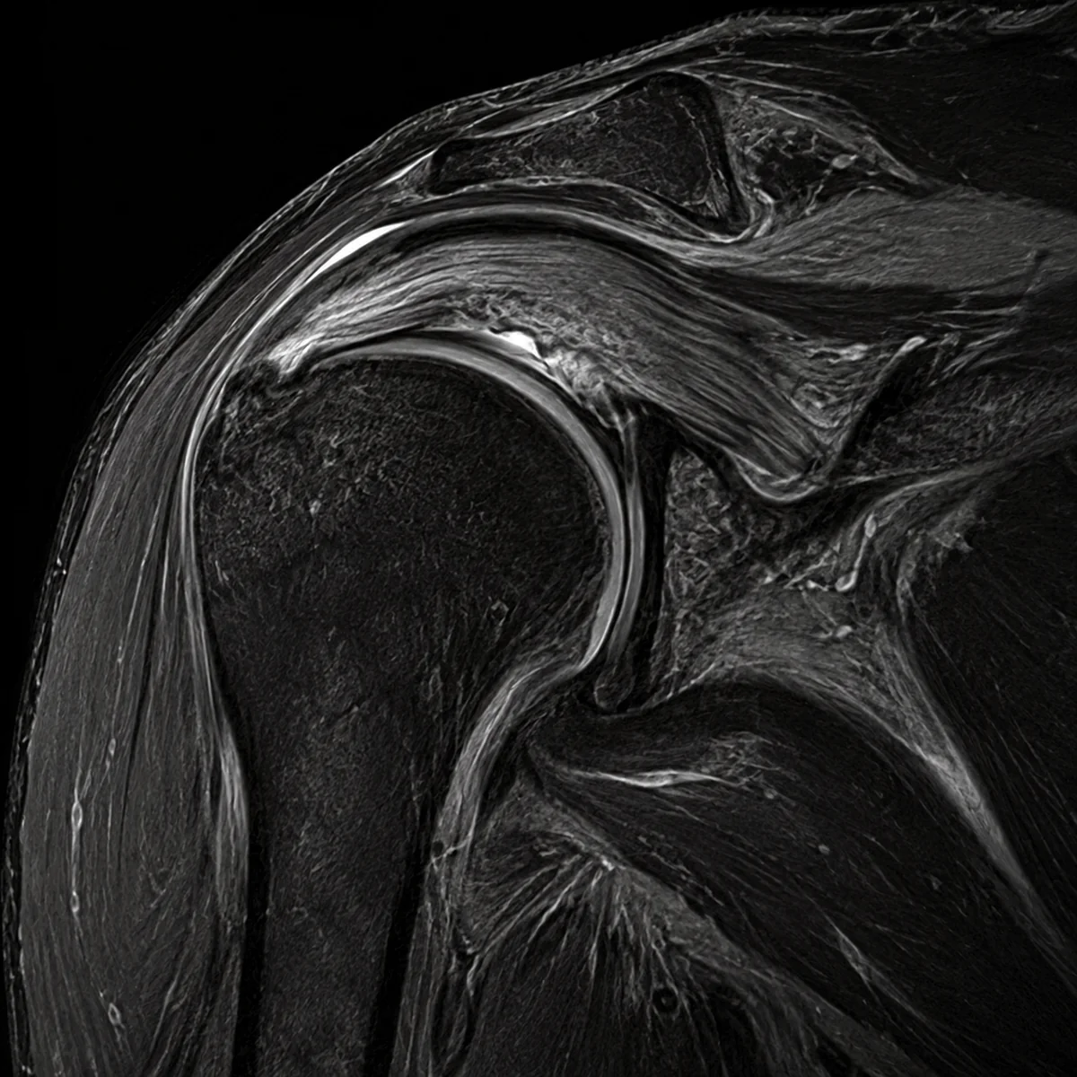 A partial tear or a worn tendon, illustrated MRI
